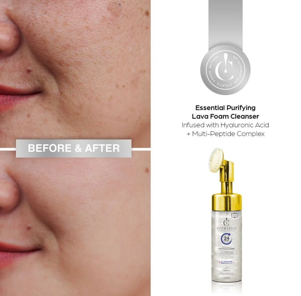 Before and after results with Inner-Cells Lava Foam Cleanser - clearer skin and key ingredients